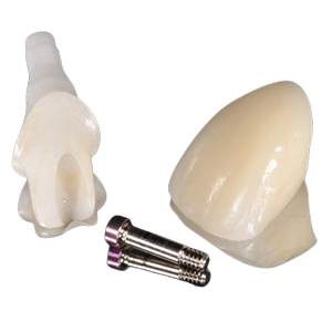 Cement Retained Implant Crowns/Bridges